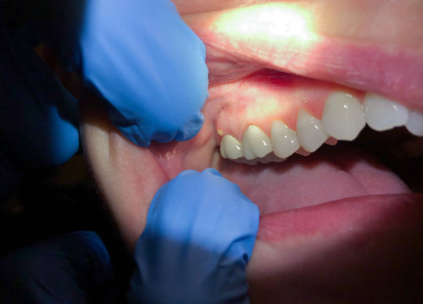 Best Emergency Tooth Extraction in Chamblee, GA